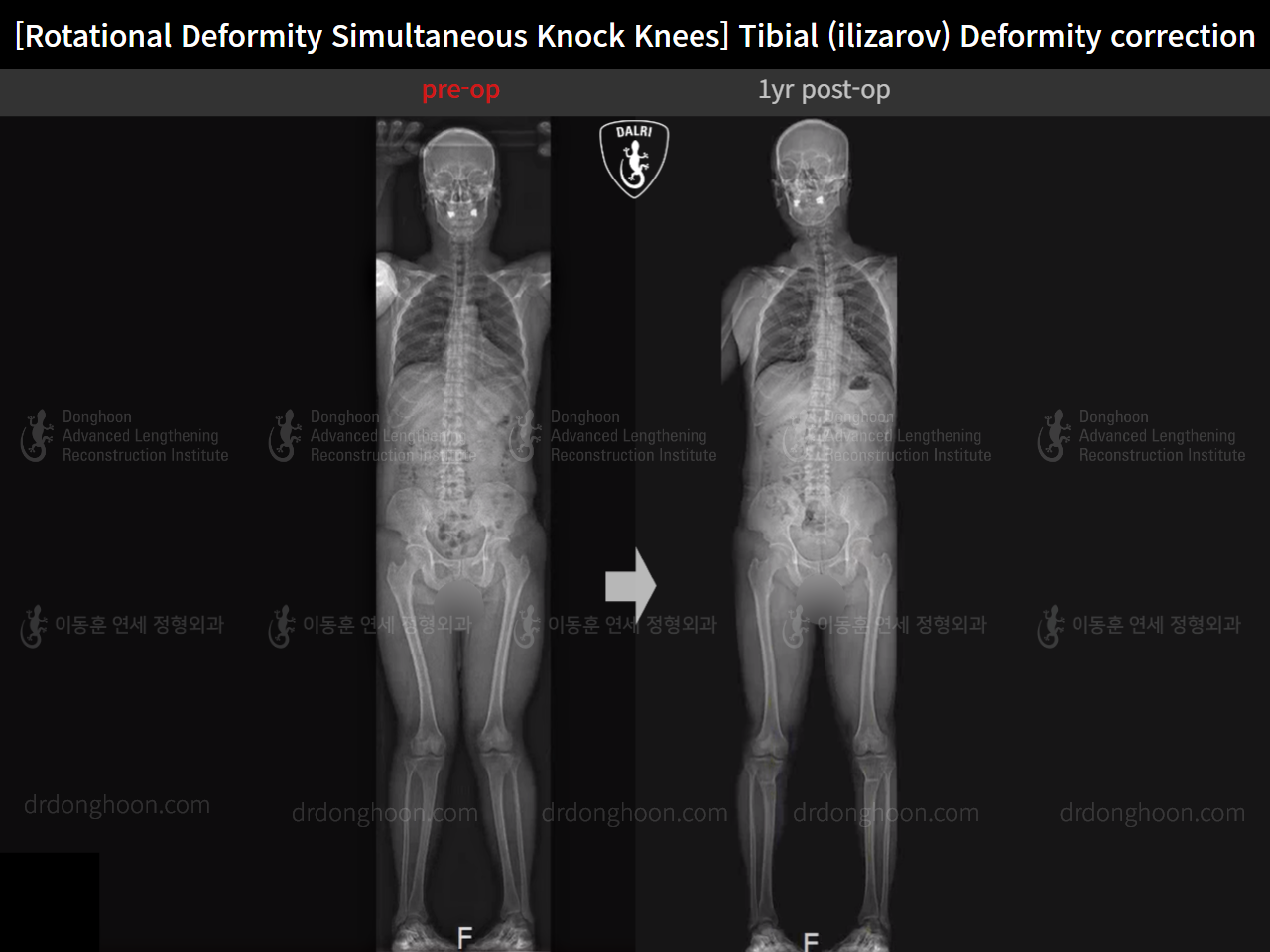 Before and after adult knock knees, case 15977455, image 9, Dr. Donghoon institute (DALRI)