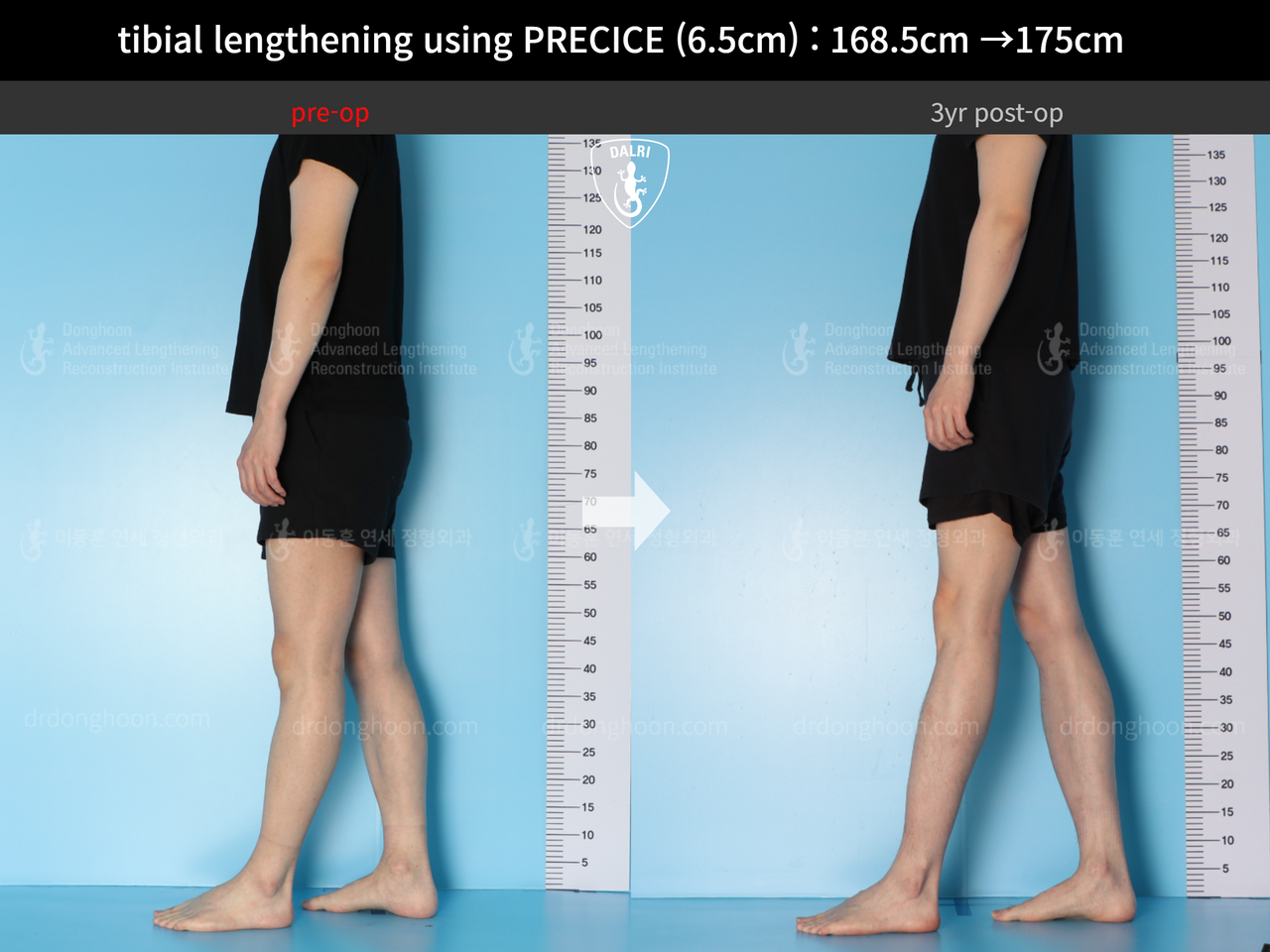 Before and after cll precice, case 13661572, image 6, Dr. Donghoon institute (DALRI)