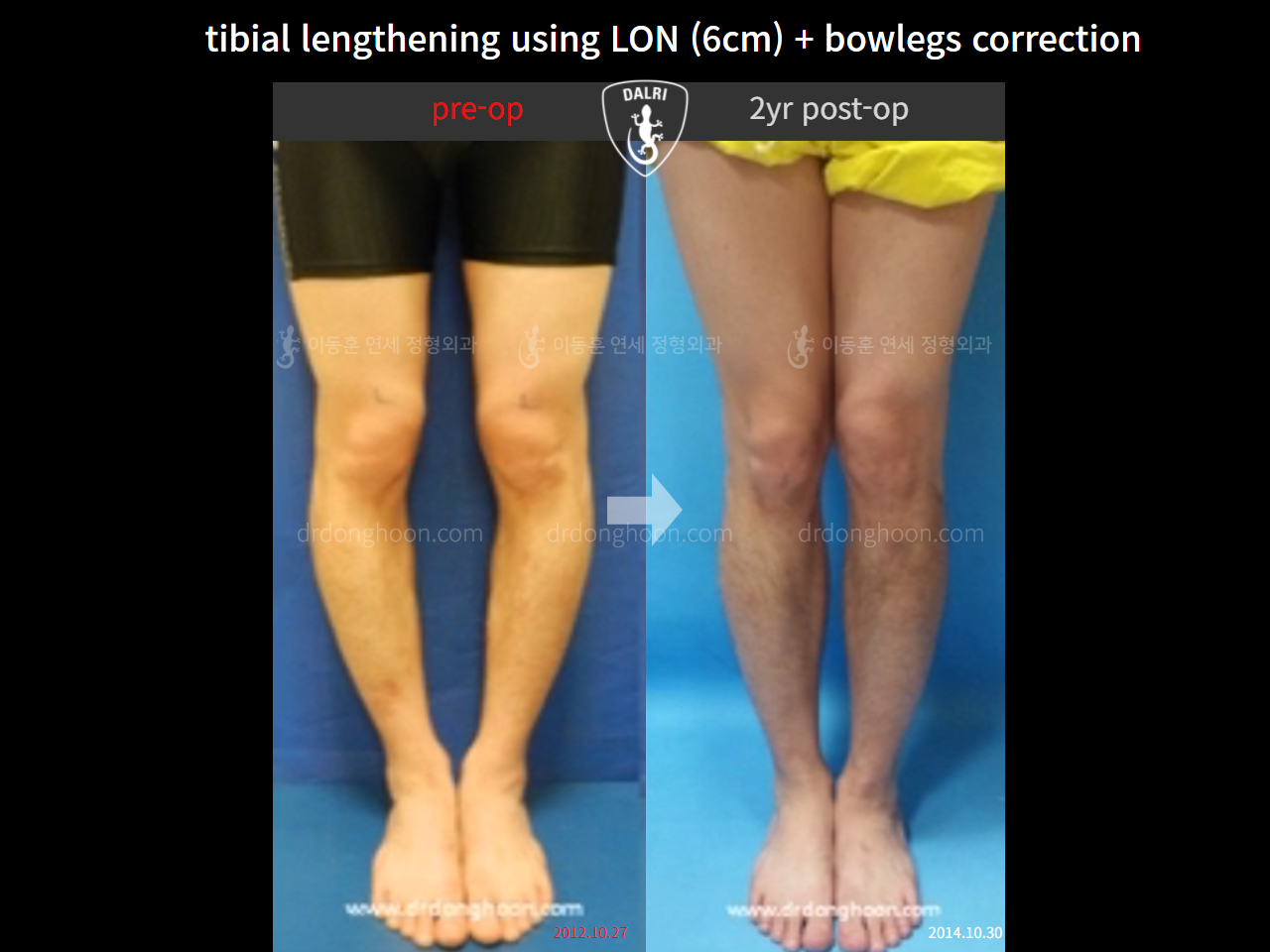 Before and after cll + deformity correction, case 4323167, image 1, Dr. Donghoon institute (DALRI)