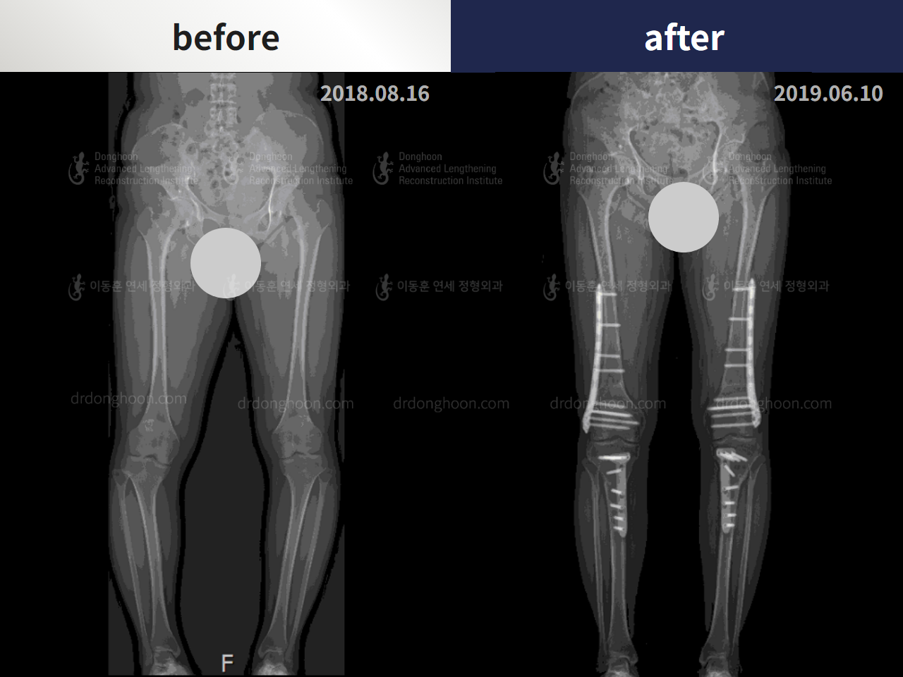Before and after congenital condition, case 4304638, image 3, Dr. Donghoon institute (DALRI)