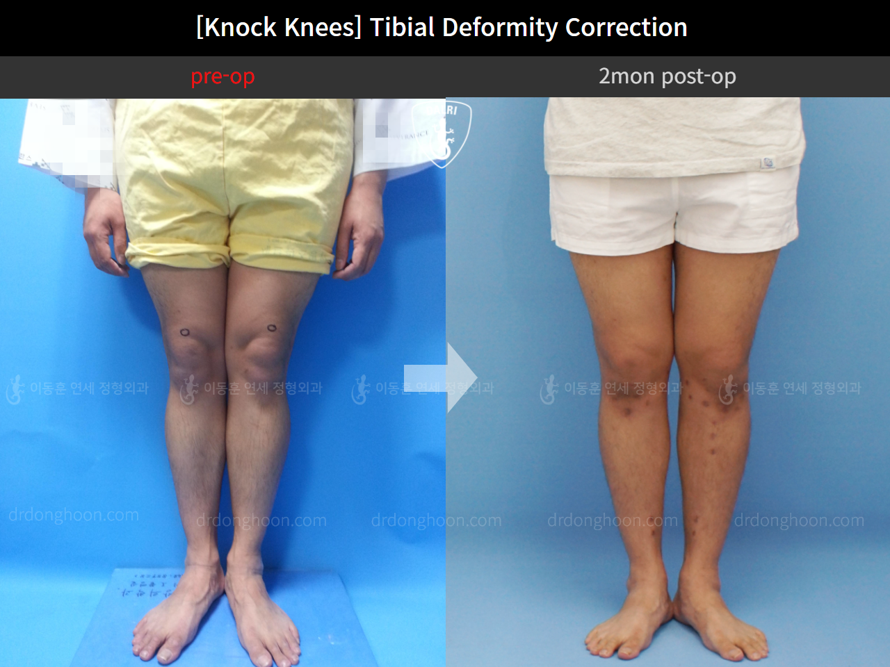 Before and after adult knock knees, case 4310814, image 2, Dr. Donghoon institute (DALRI)