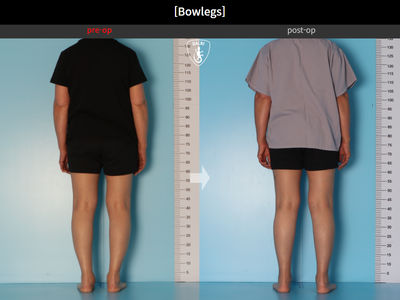 Before and after adult bowlegs, case 30770070, image 5, Dr. Donghoon institute (DALRI)