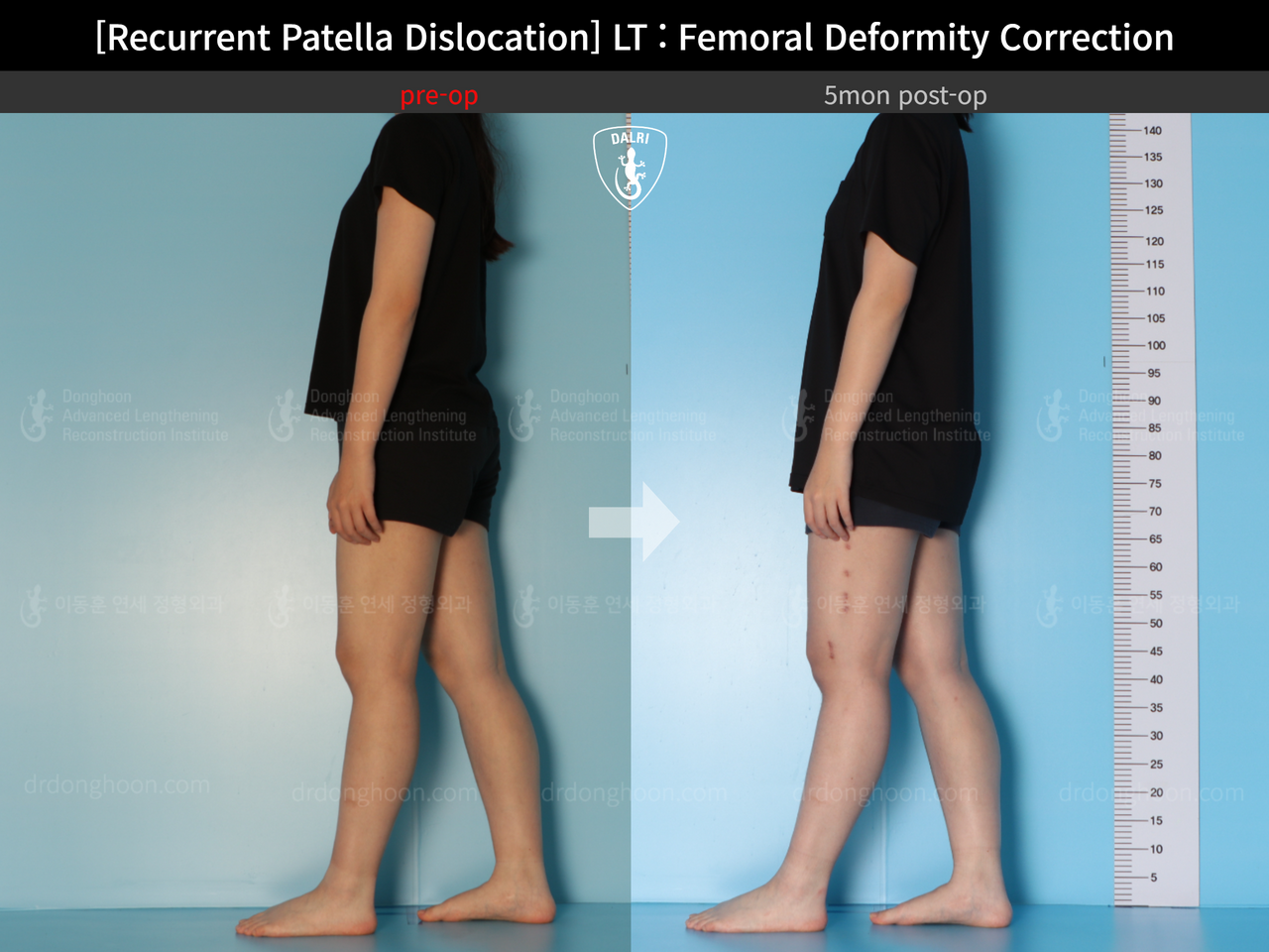 Before and after recurrent patella dislocation, case 13337596, image 4, Dr. Donghoon institute (DALRI)