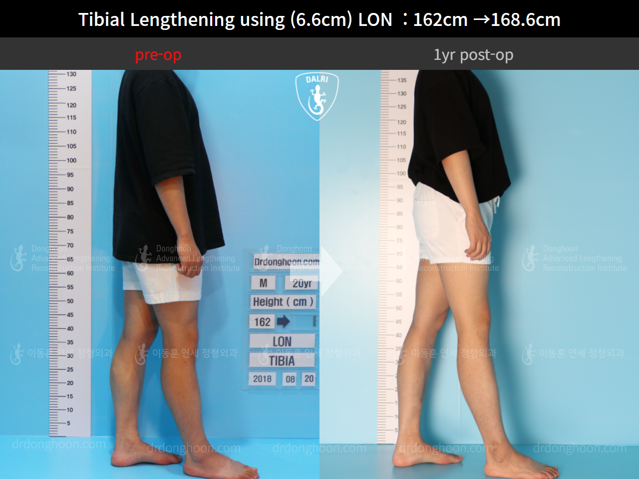 Before and after cll lon, case 4577769, image 4, Dr. Donghoon institute (DALRI)