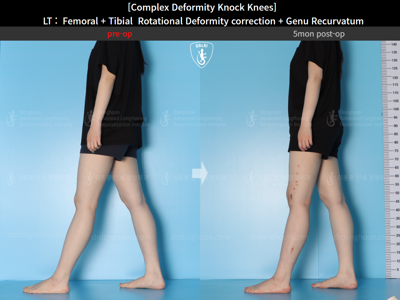 Before and after adult knock knees, case 16212764, image 6, Dr. Donghoon institute (DALRI)