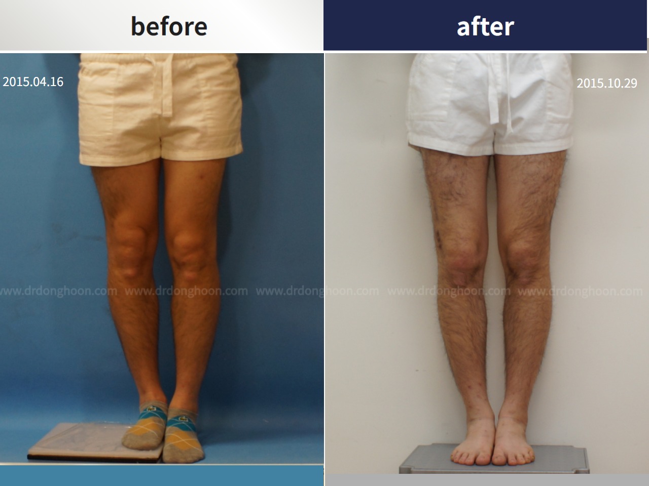 Before and after adult lld, case 4320319, image 1, Dr. Donghoon institute (DALRI)