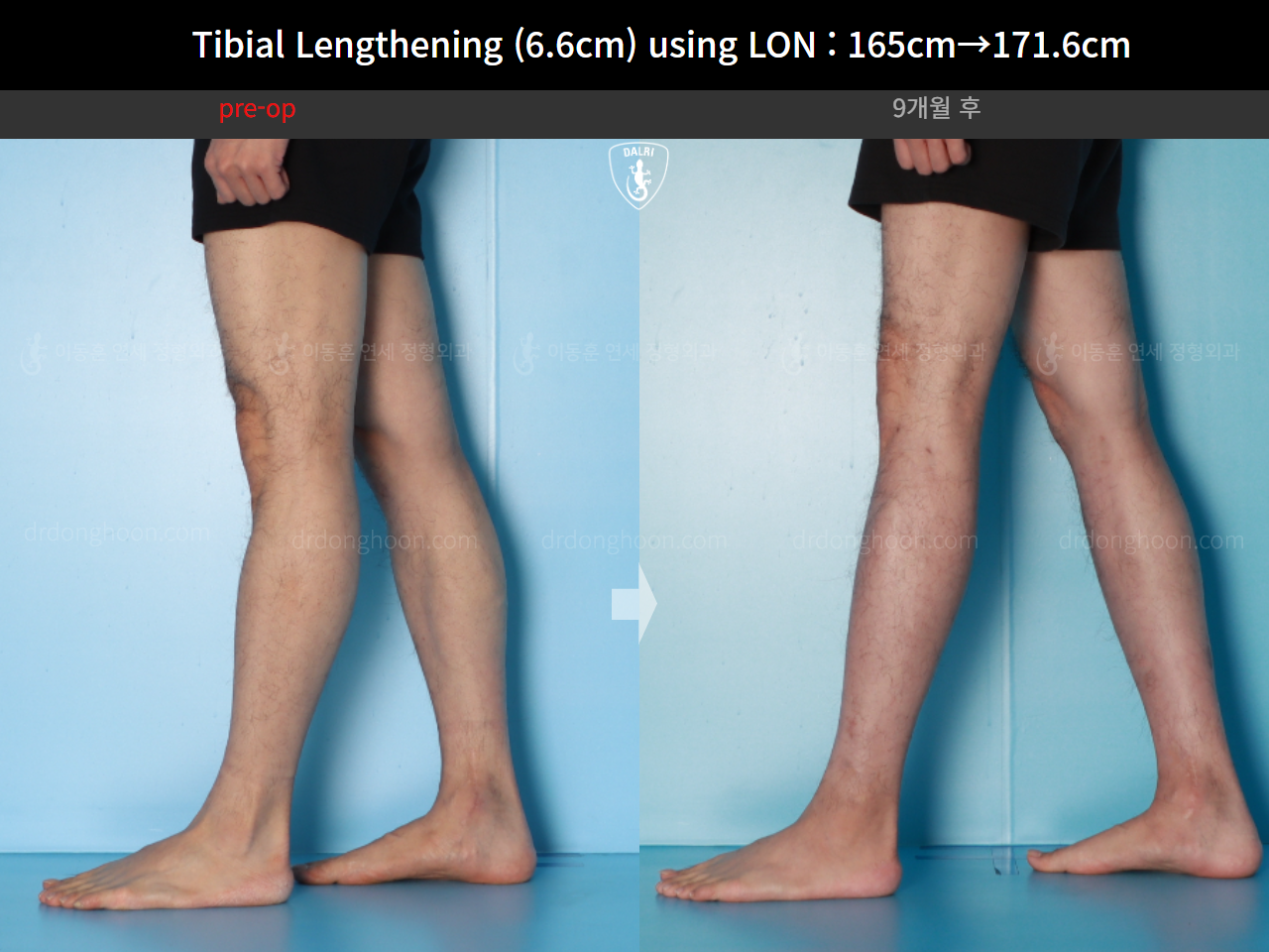 Before and after cll lon, case 16780660, image 11, Dr. Donghoon institute (DALRI)