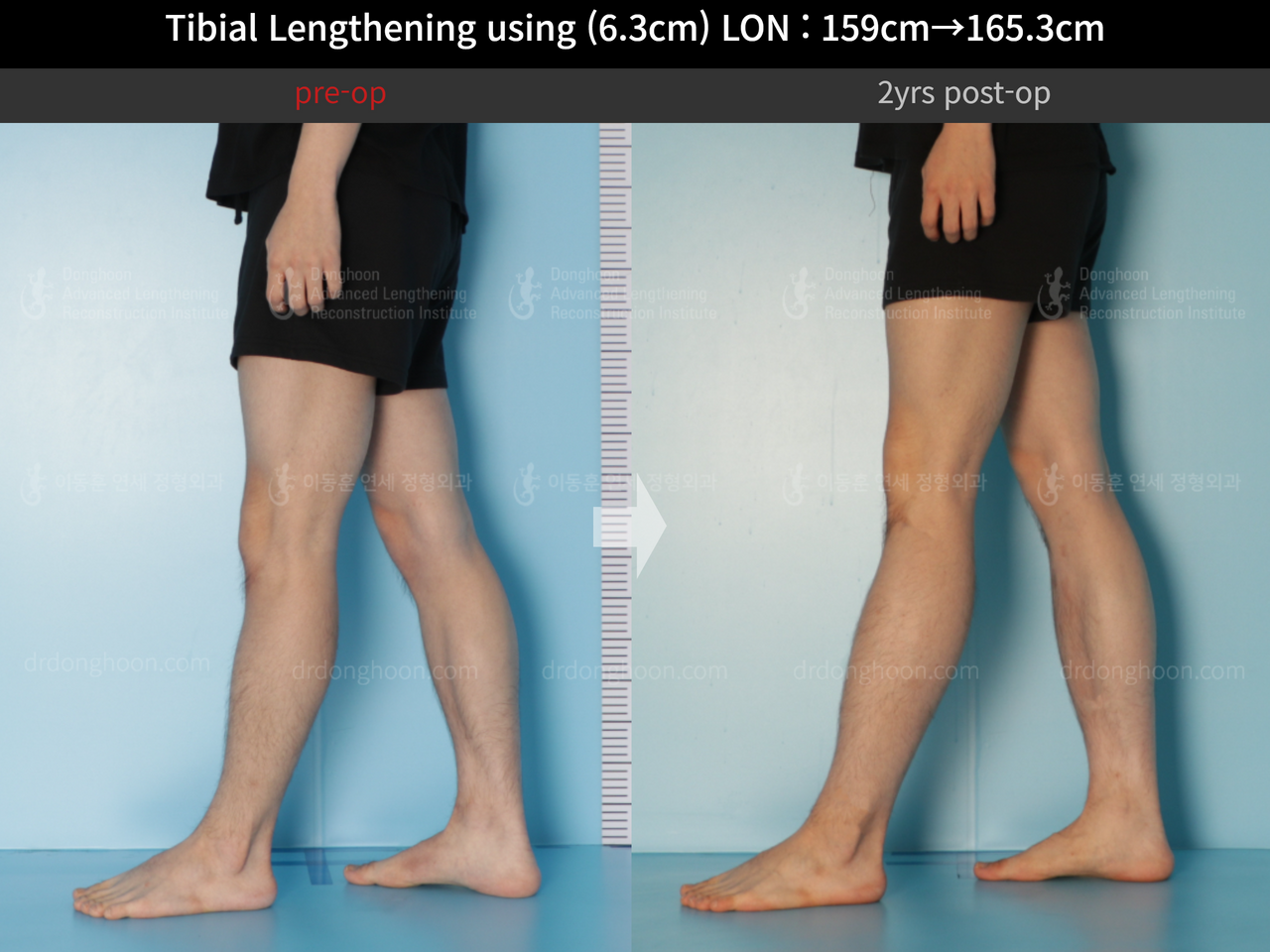 Before and after cll lon, case 12096536, image 10, Dr. Donghoon institute (DALRI)