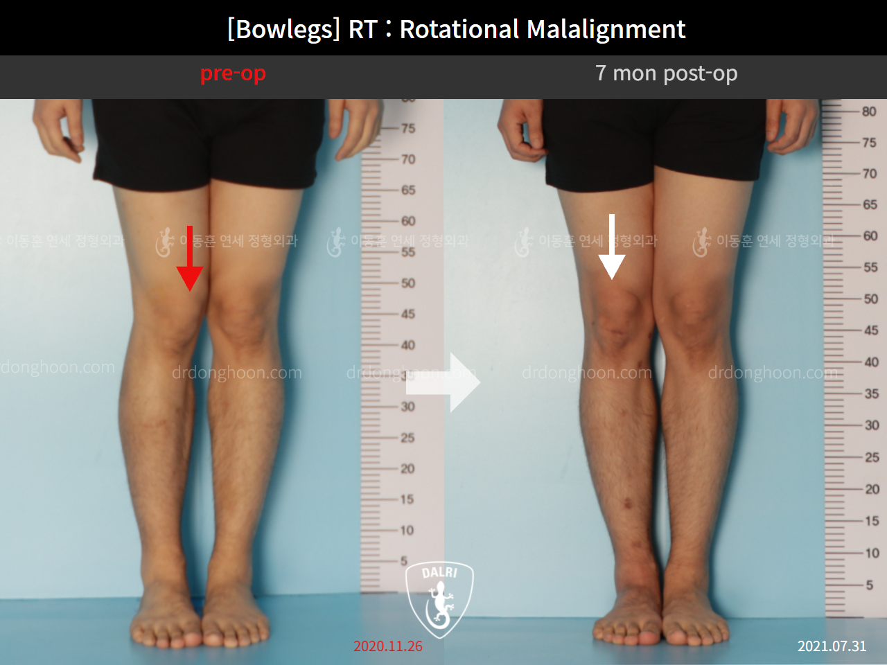Before and after adult bowlegs, case 9190873, image 2, Dr. Donghoon institute (DALRI)