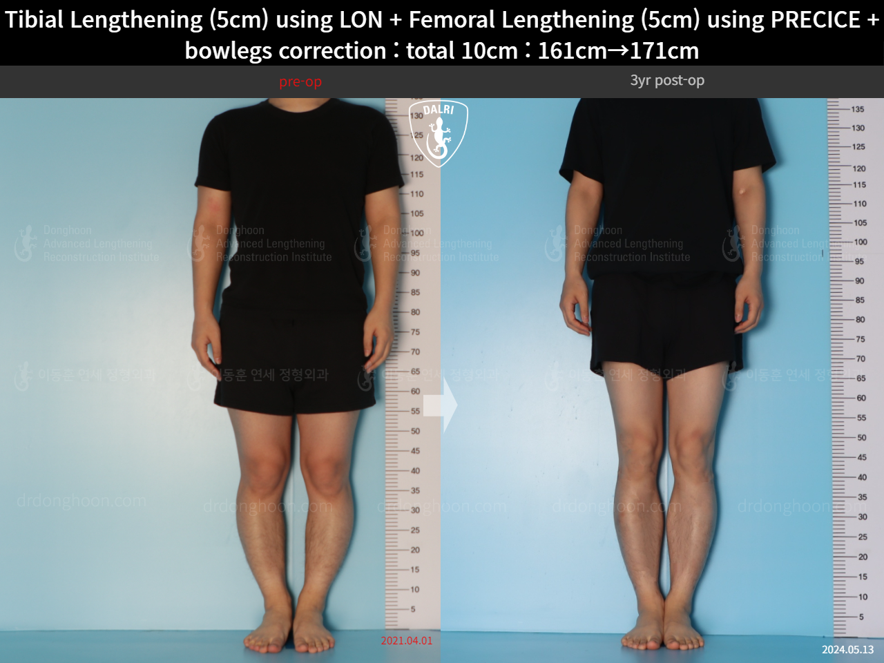 Before and after cll precice, case 22208321, image 3, Dr. Donghoon institute (DALRI)