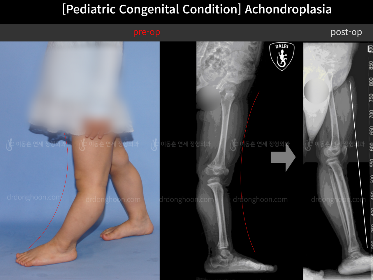 Before and after paediatric congenital condition, case 12617803, image 3, Dr. Donghoon institute (DALRI)