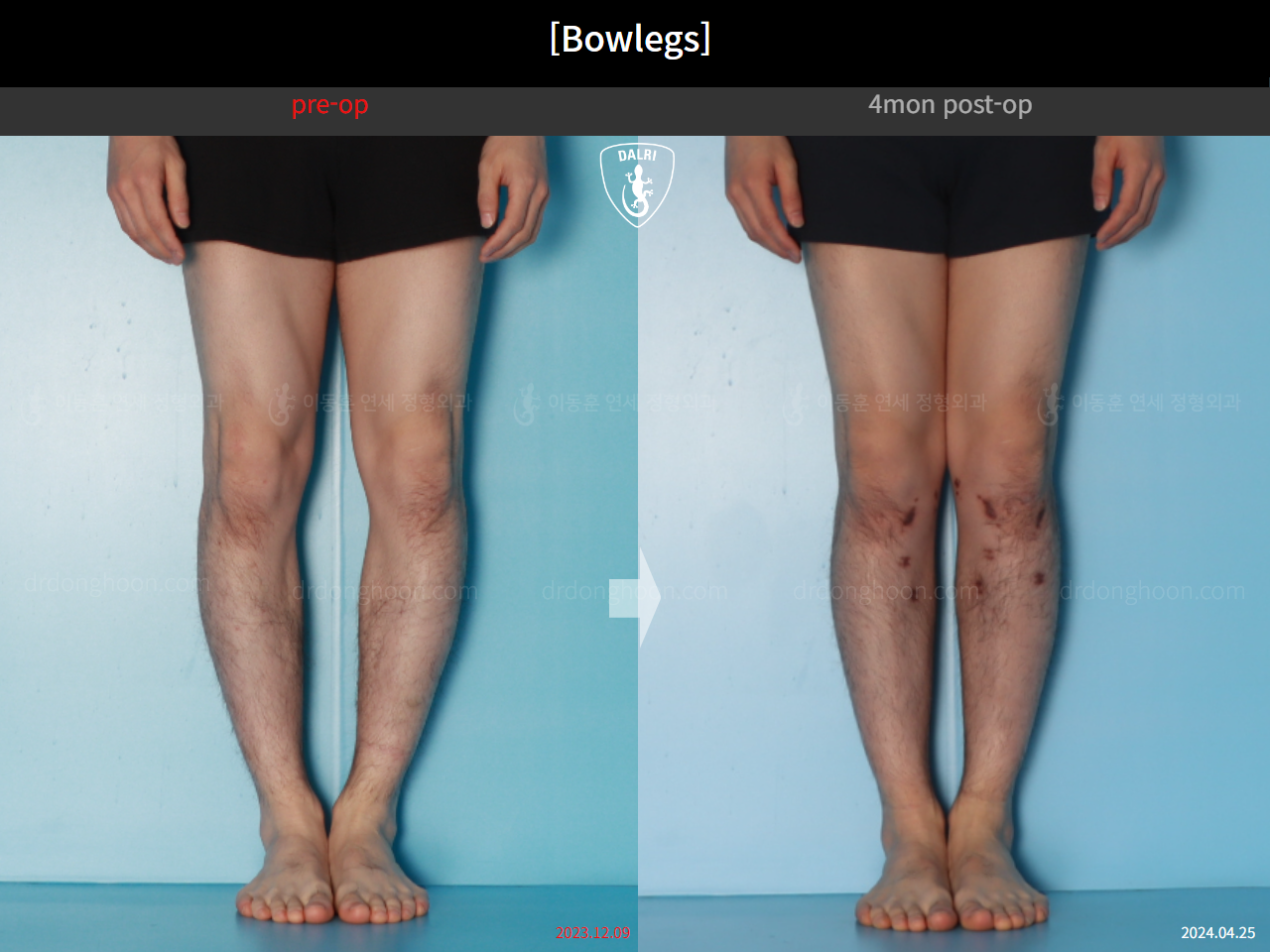 Before and after adult bowlegs, case 21098909, image 6, Dr. Donghoon institute (DALRI)