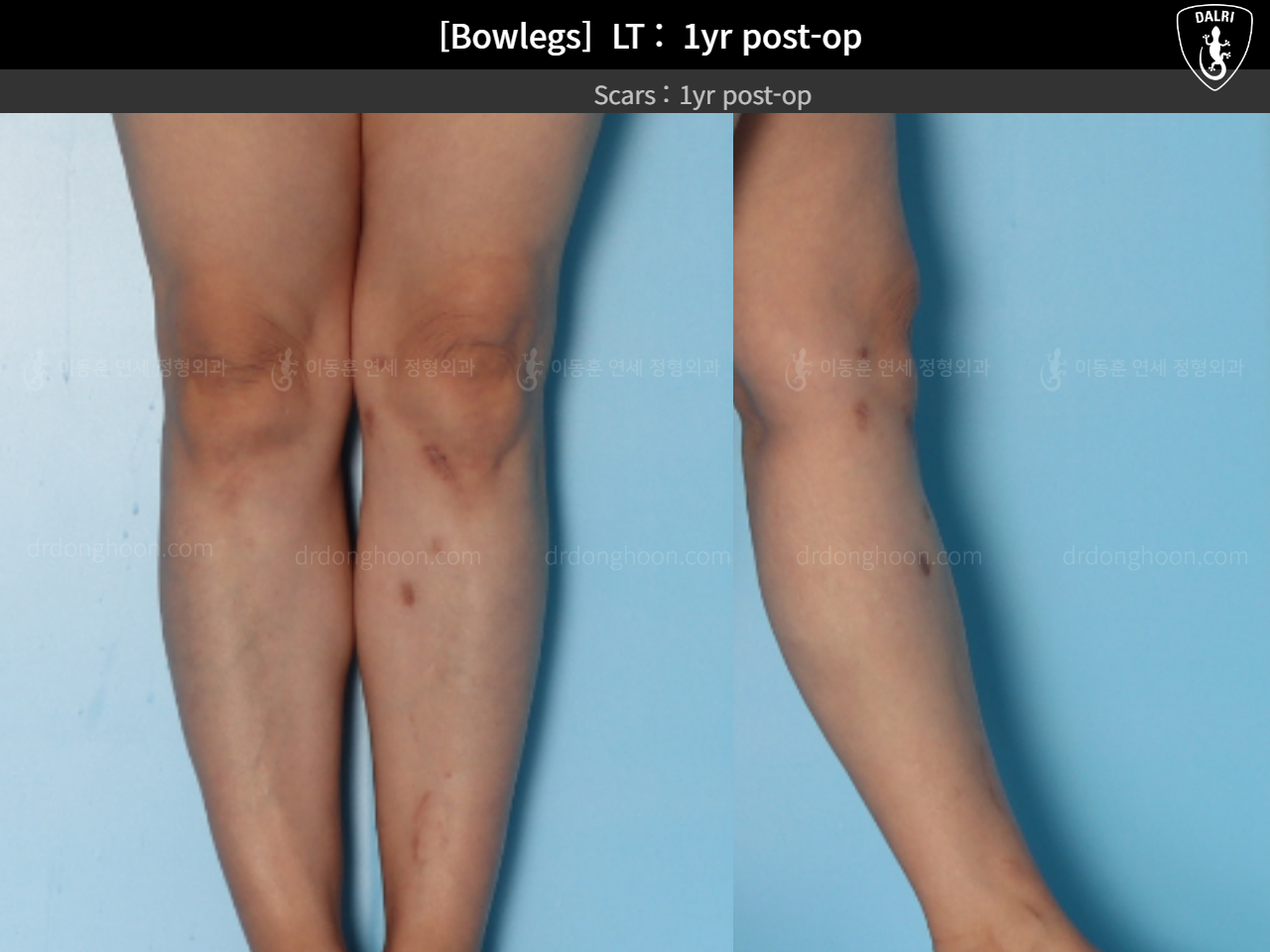 Before and after adult bowlegs, case 15172734, image 10, Dr. Donghoon institute (DALRI)