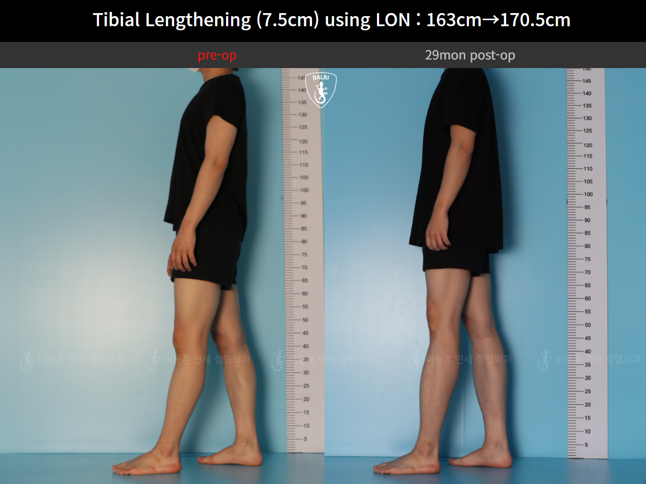 Before and after cll lon, case 127341676, image 5, Dr. Donghoon institute (DALRI)