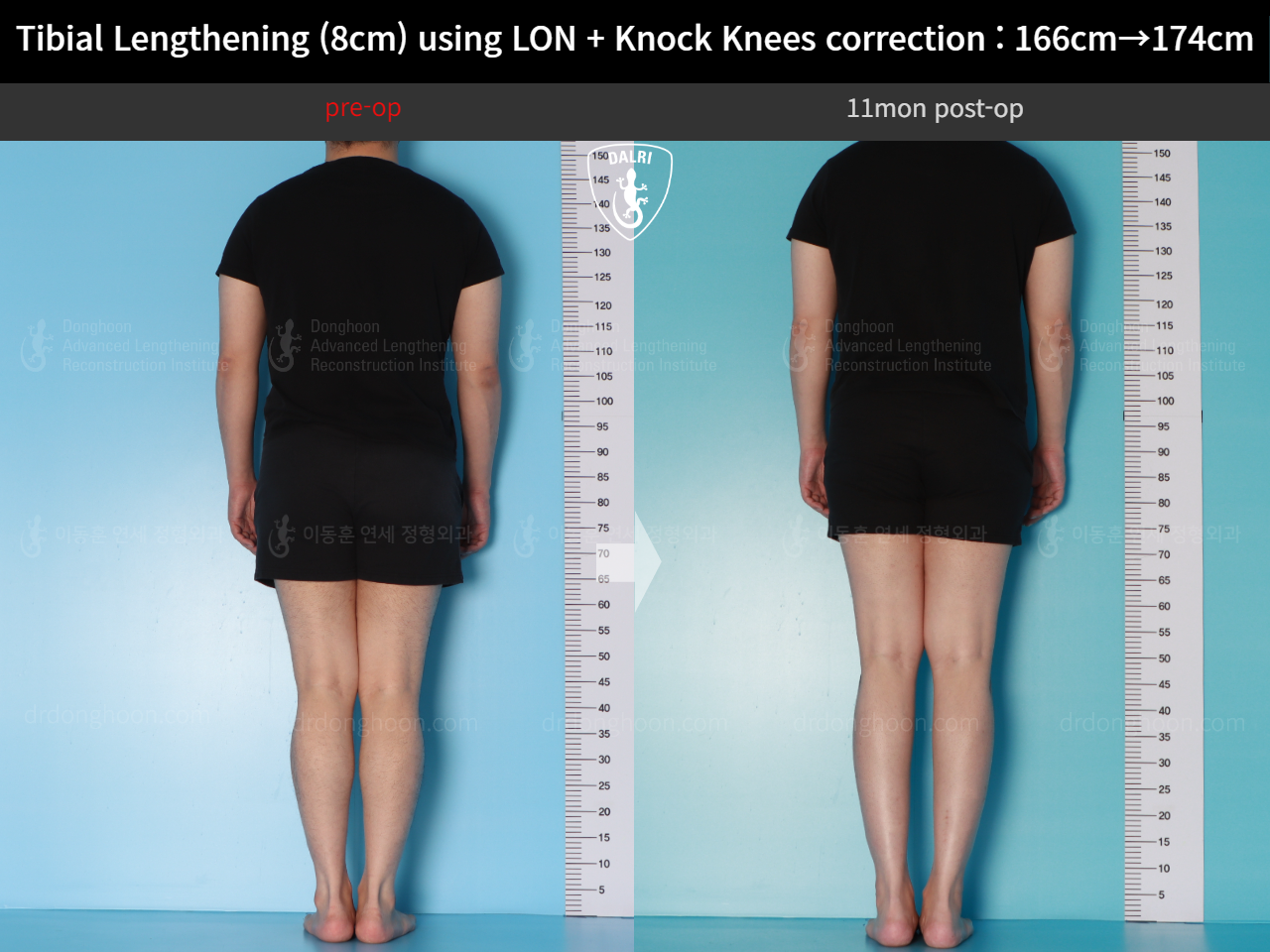 Before and after cll + deformity correction, case 20789954, image 2, Dr. Donghoon institute (DALRI)