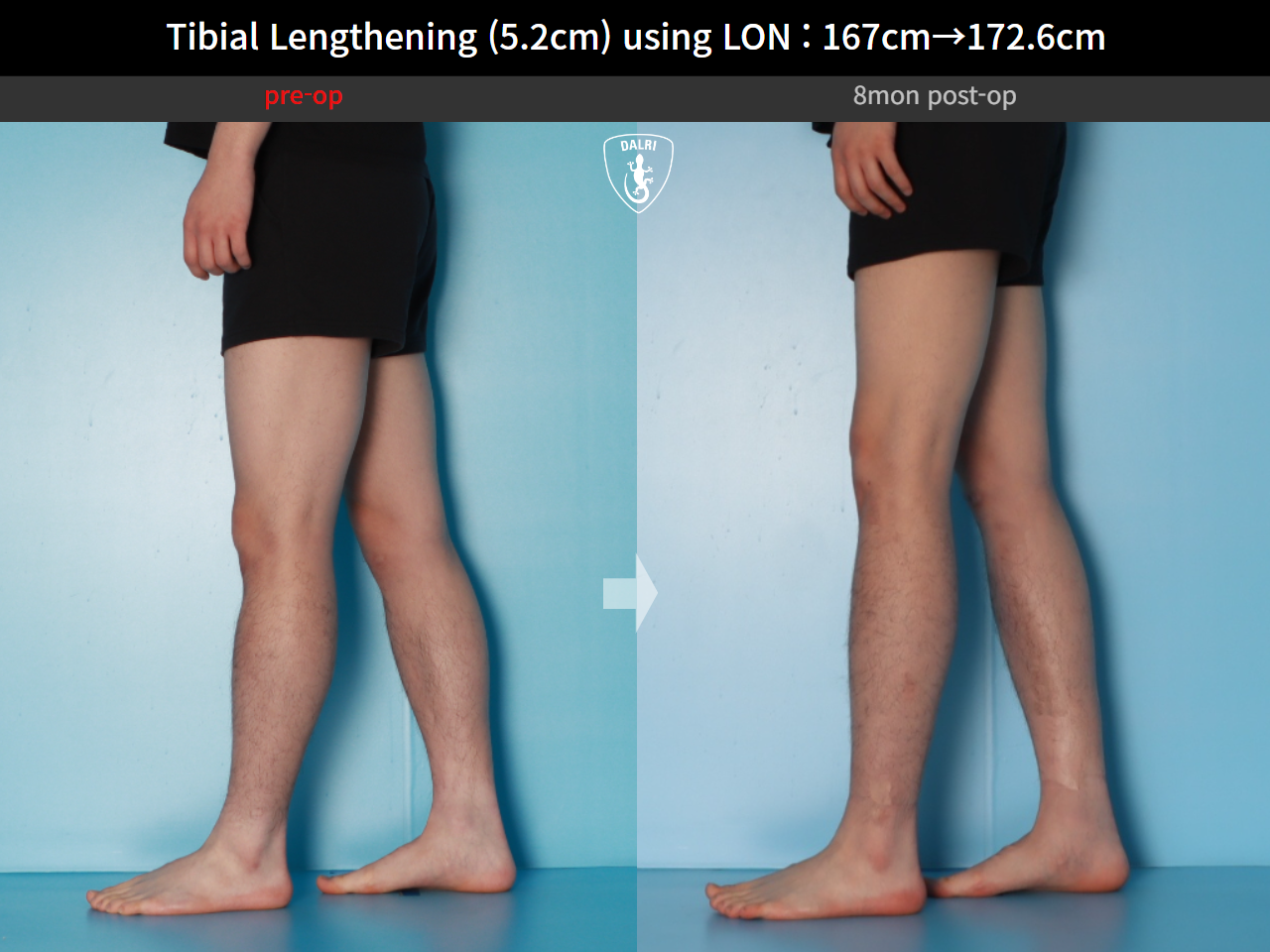 Before and after cll lon, case 29672720, image 9, Dr. Donghoon institute (DALRI)