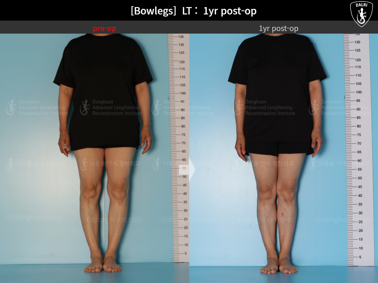 Before and after adult bowlegs, case 15172734, image 6, Dr. Donghoon institute (DALRI)