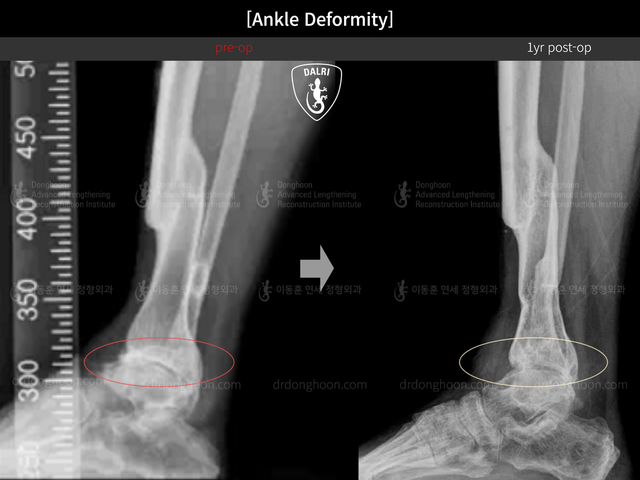Before and after foot & ankle deformity, case 13580612, image 6, Dr. Donghoon institute (DALRI)