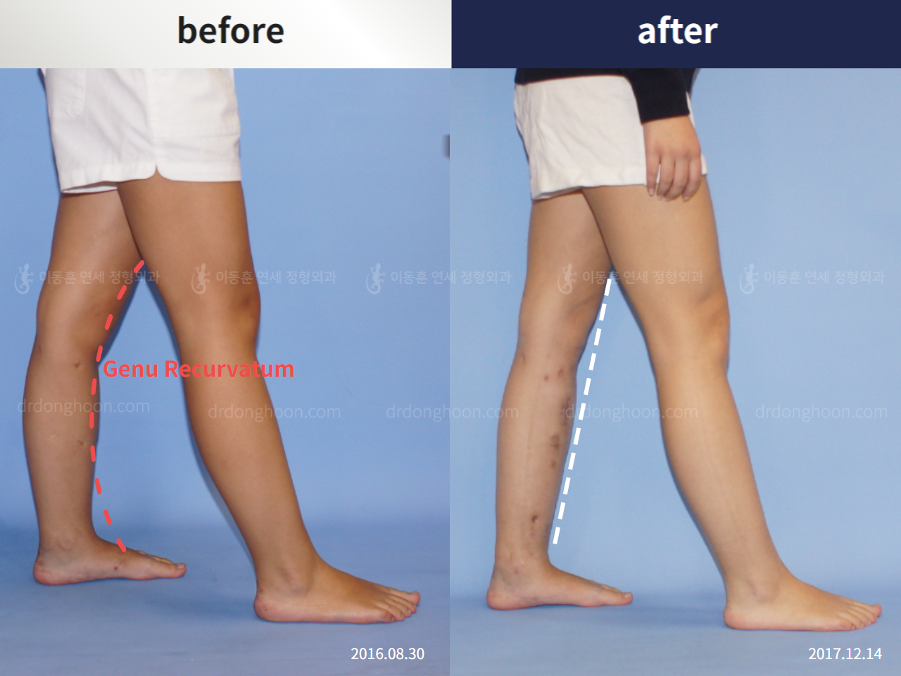 Before and after genu recurvatum, case 5301894, image 2, Dr. Donghoon institute (DALRI)