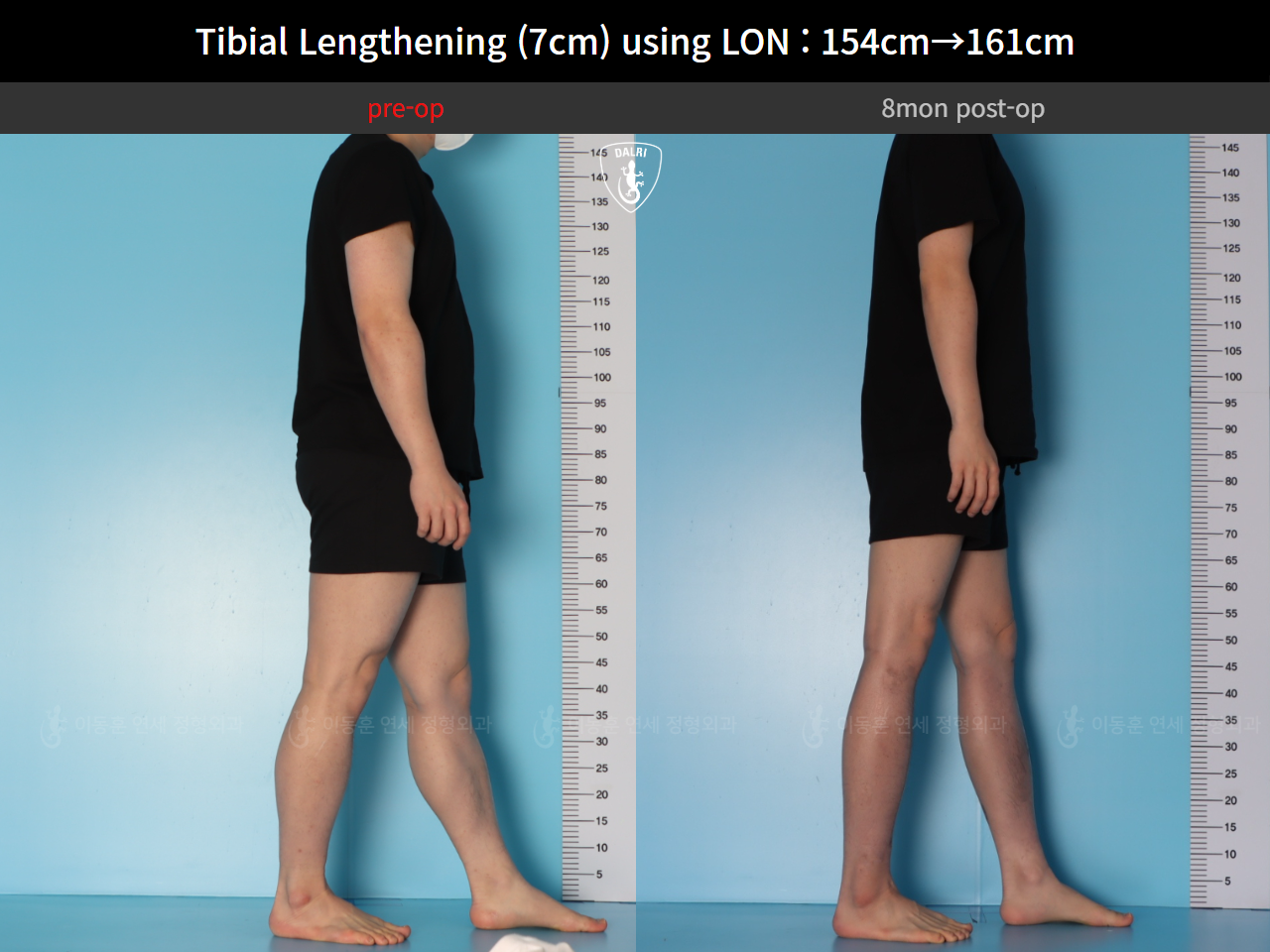 Before and after cll lon, case 127519935, image 8, Dr. Donghoon institute (DALRI)