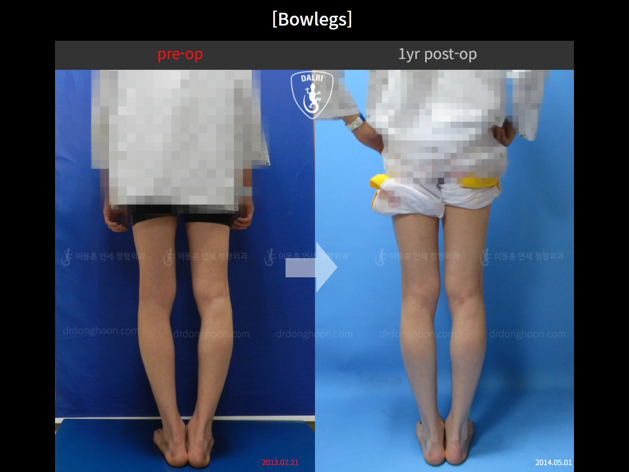 Before and after adult bowlegs, case 10571885, image 3, Dr. Donghoon institute (DALRI)