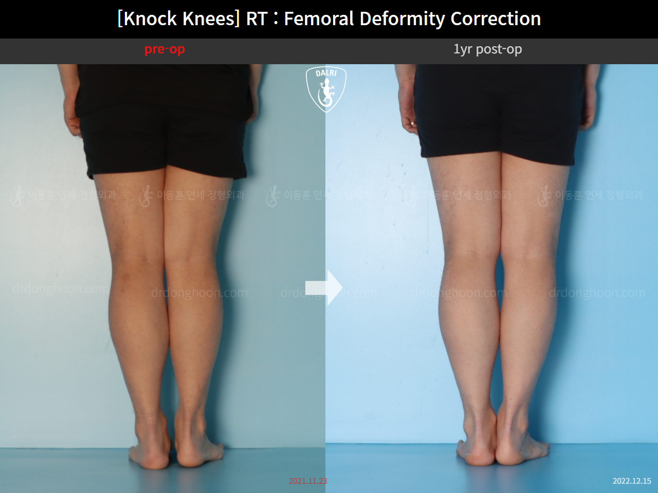 Before and after adult knock knees, case 15950751, image 11, Dr. Donghoon institute (DALRI)