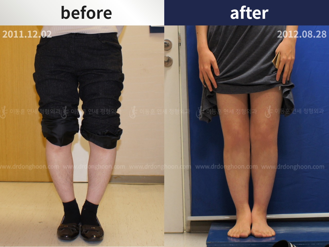 Before and after adult bowlegs, case 4311077, image 1, Dr. Donghoon institute (DALRI)