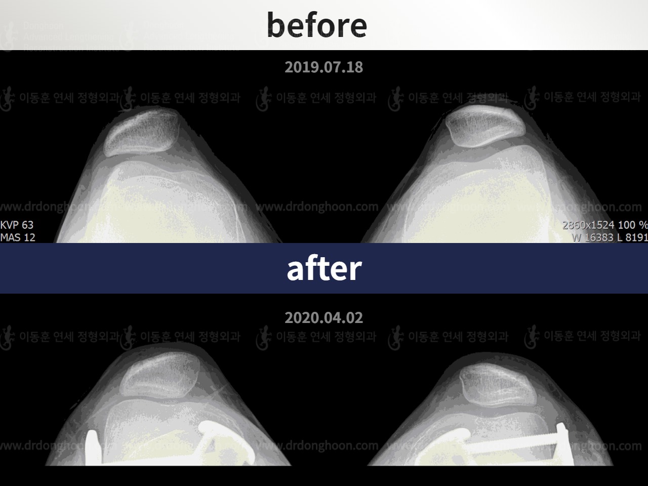 Before and after paediatric & adolescent bowlegs, case 4585796, image 4, Dr. Donghoon institute (DALRI)