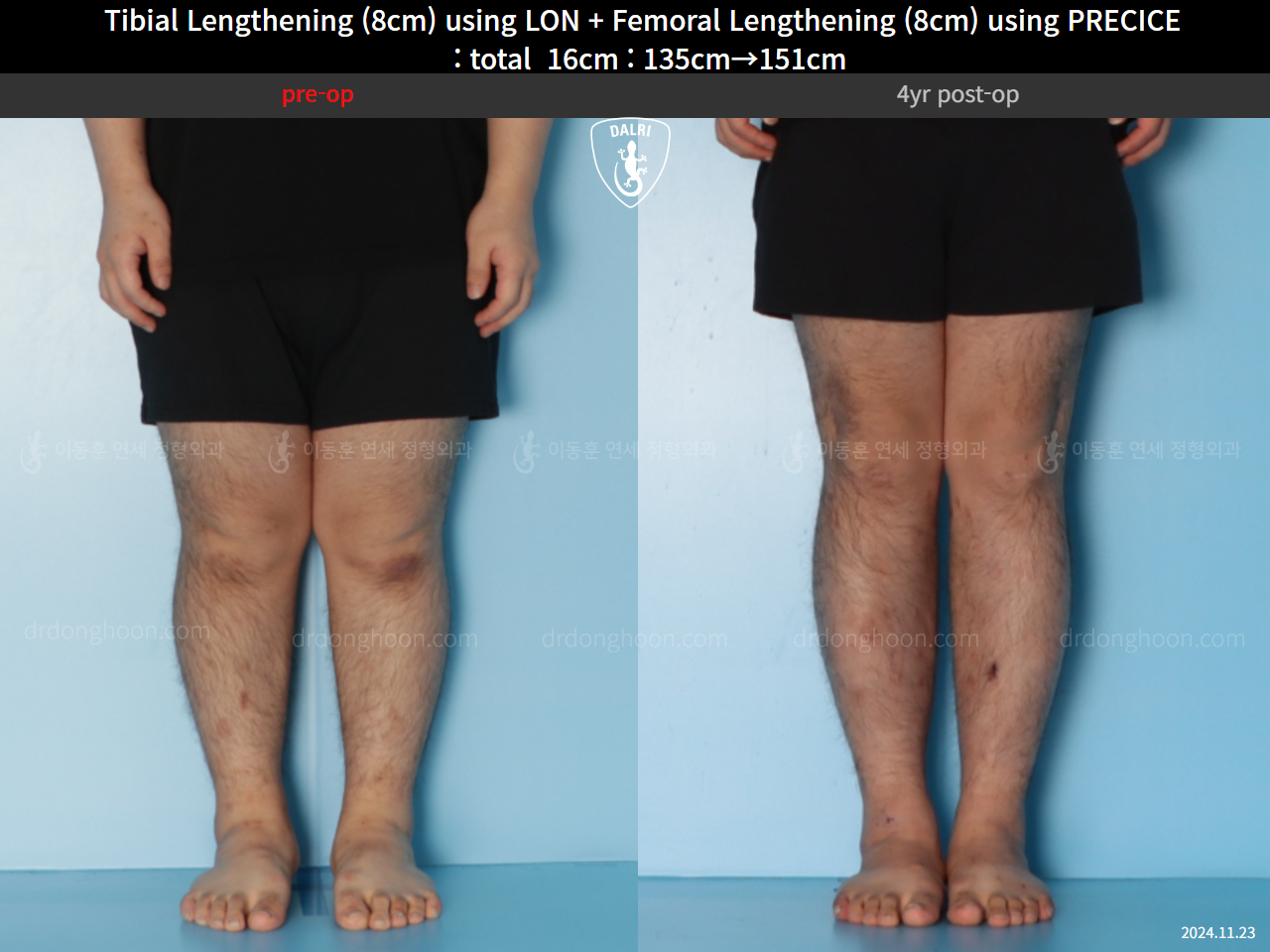Before and after cll precice, case 128435842, image 6, Dr. Donghoon institute (DALRI)
