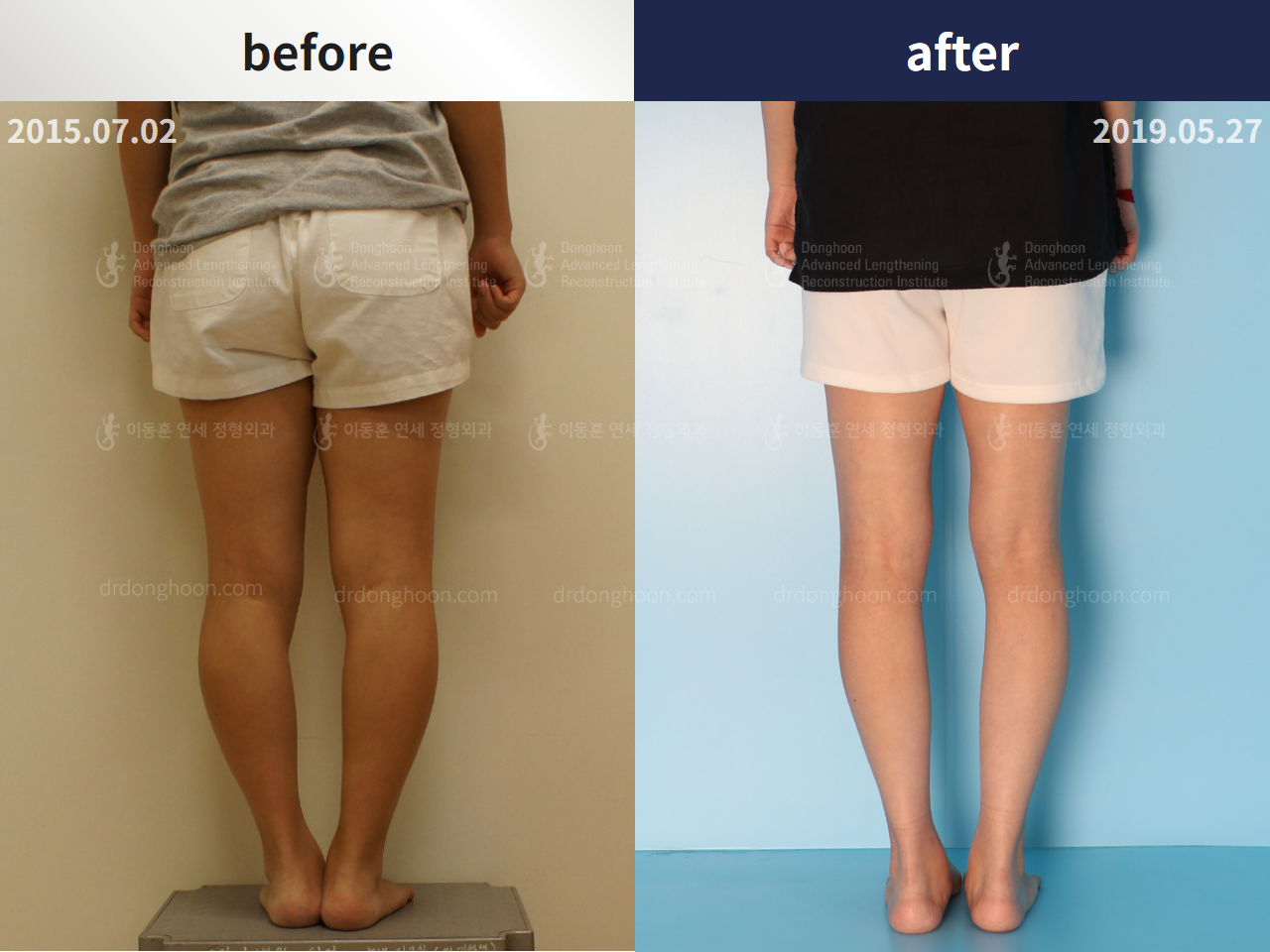 Before and after congenital condition, case 4304651, image 2, Dr. Donghoon institute (DALRI)