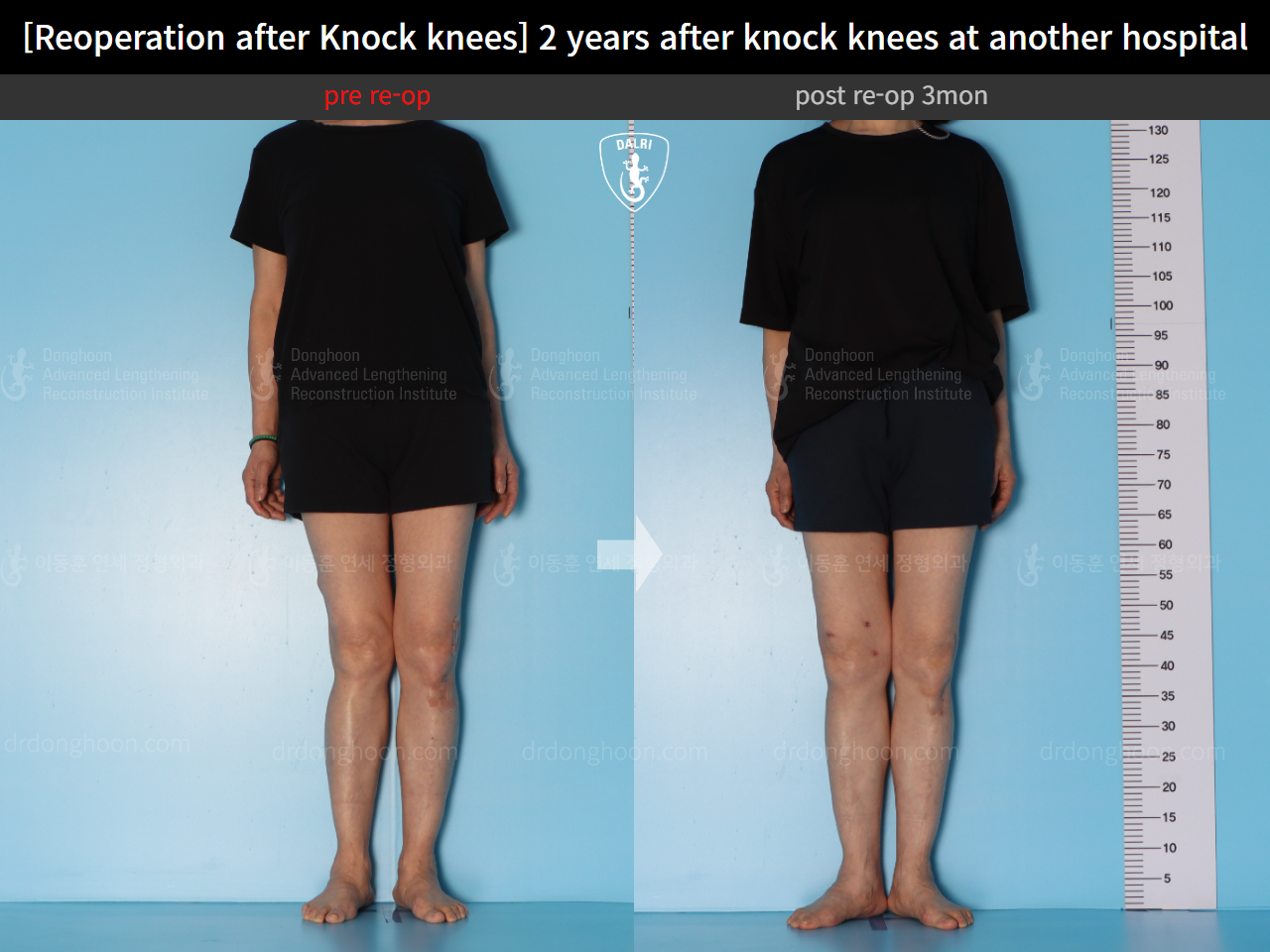 Before and after reoperation after deformity correction, case 15622876, image 2, Dr. Donghoon institute (DALRI)