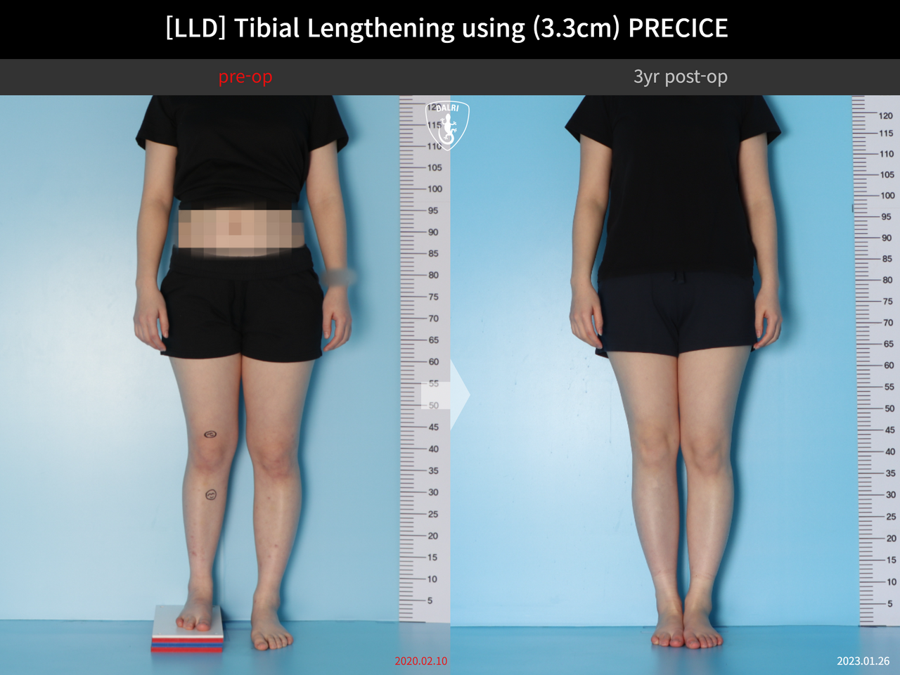 Before and after adult lld, case 14064905, image 3, Dr. Donghoon institute (DALRI)