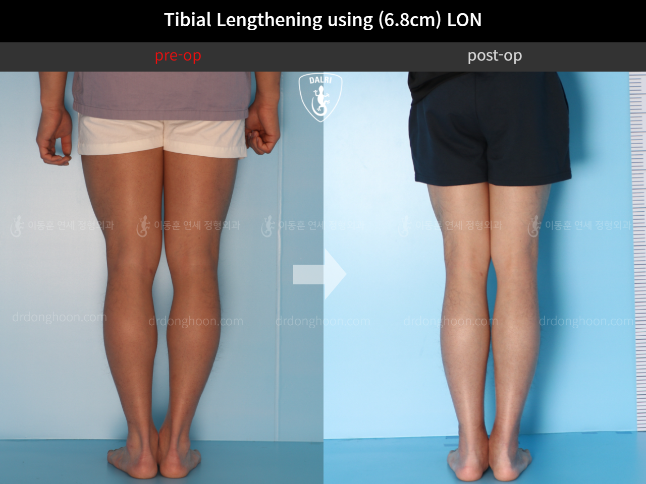 Before and after cll lon, case 4577738, image 6, Dr. Donghoon institute (DALRI)