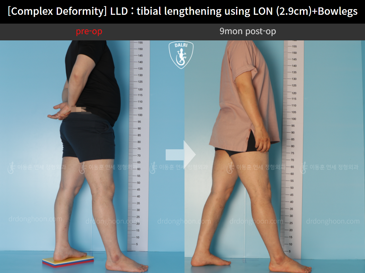 Before and after adult lld, case 11233977, image 3, Dr. Donghoon institute (DALRI)