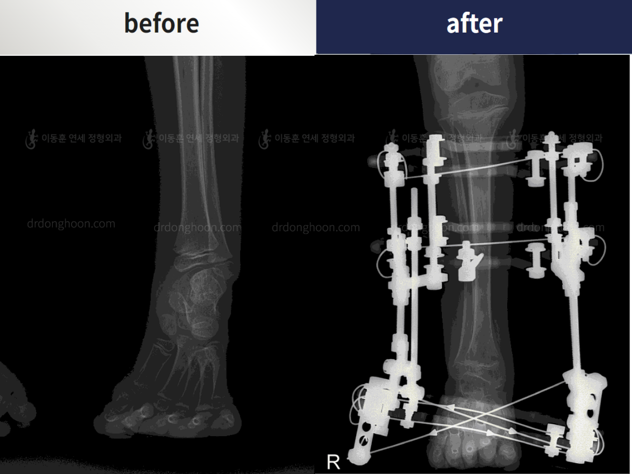 Before and after foot & ankle deformity, case 4367971, image 4, Dr. Donghoon institute (DALRI)
