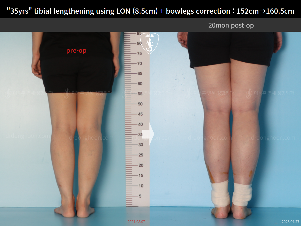 Before and after cll + deformity correction, case 15036694, image 8, Dr. Donghoon institute (DALRI)