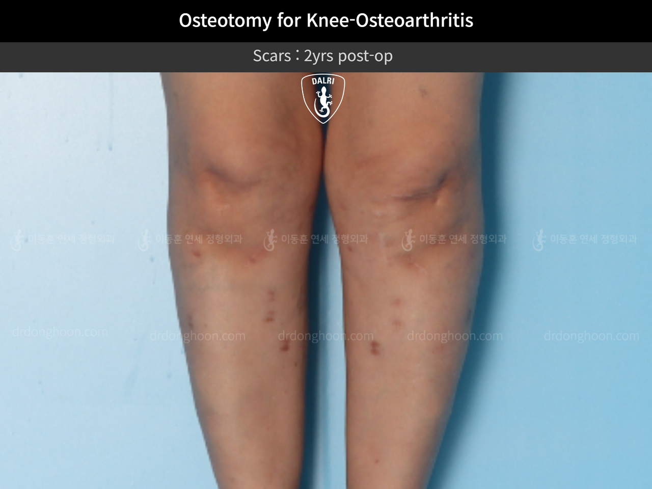 Before and after osteotomy for knee osteoarthritis, case 12844528, image 9, Dr. Donghoon institute (DALRI)