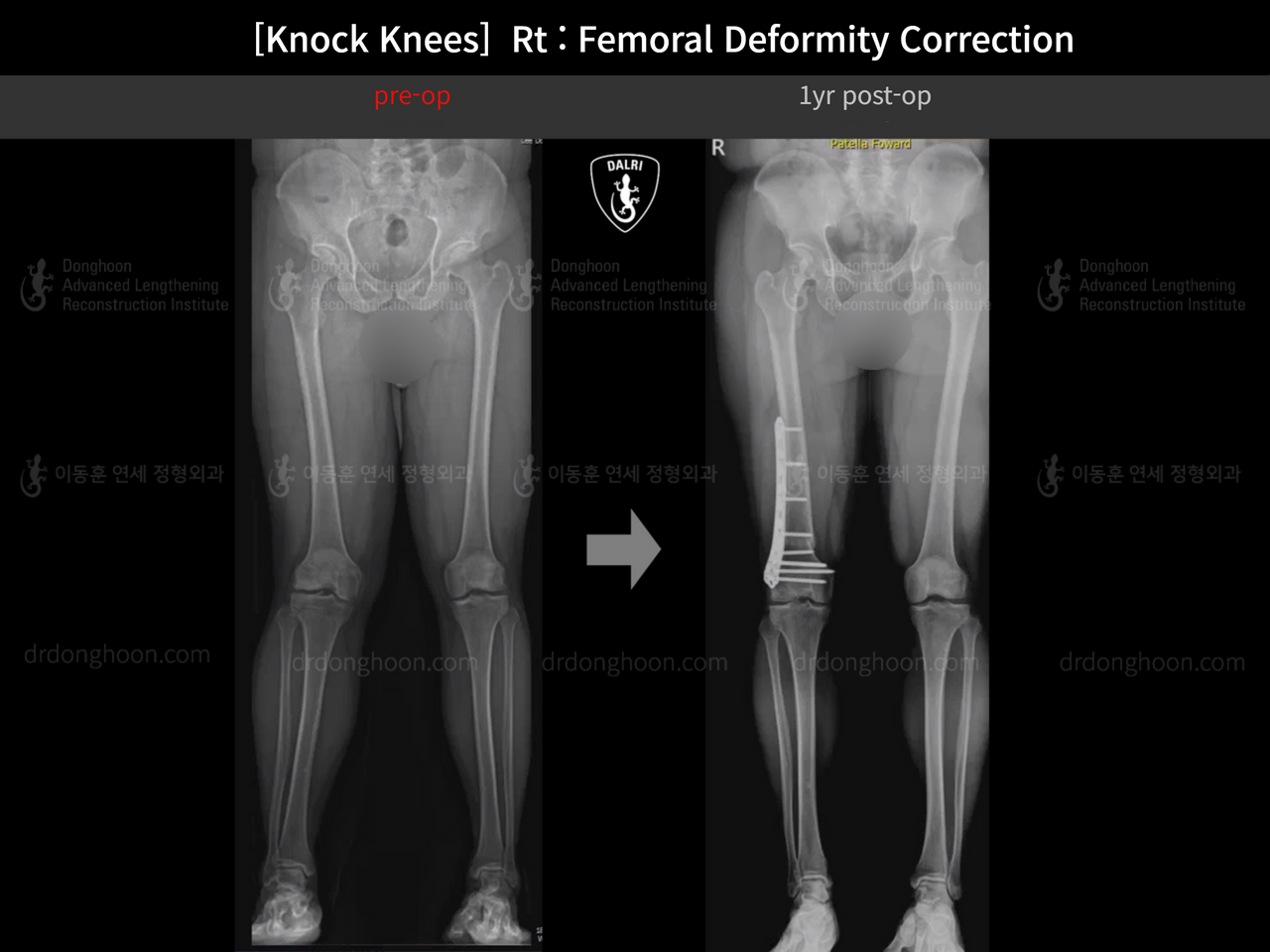 Before and after adult knock knees, case 14009233, image 7, Dr. Donghoon institute (DALRI)