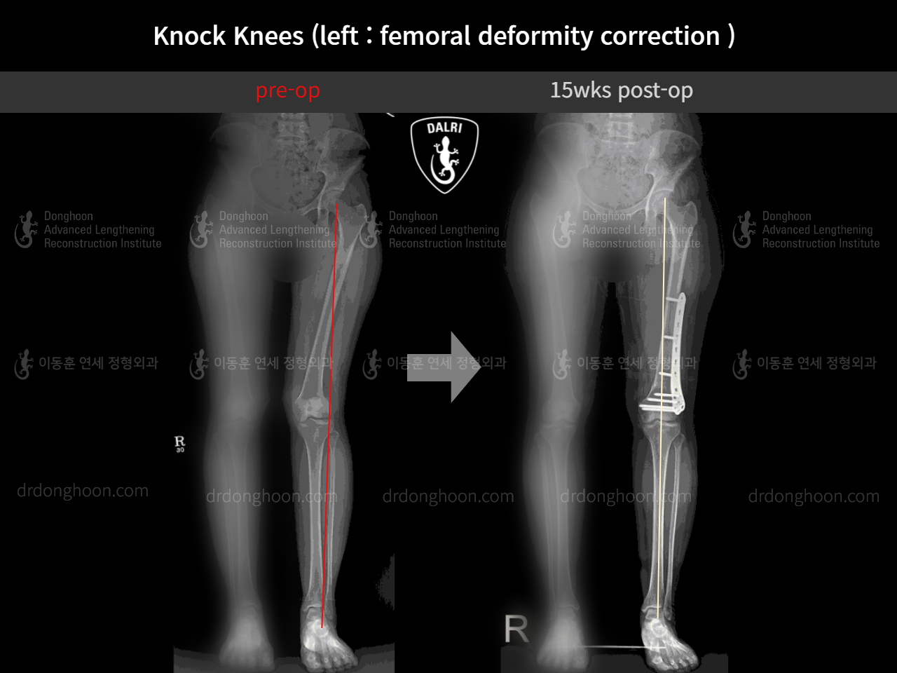 Before and after adult knock knees, case 8259194, image 5, Dr. Donghoon institute (DALRI)