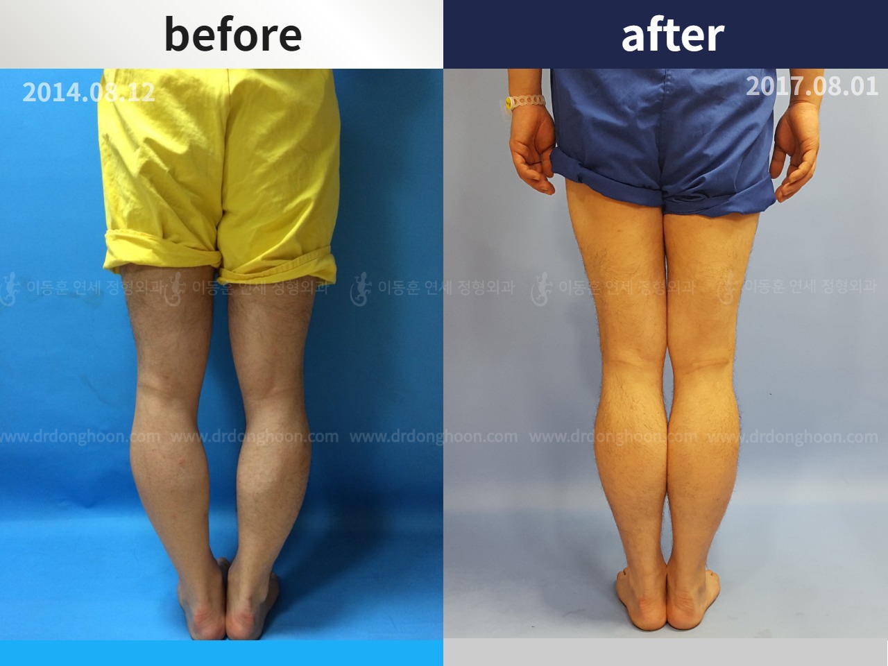 Before and after adult bowlegs, case 4311099, image 2, Dr. Donghoon institute (DALRI)