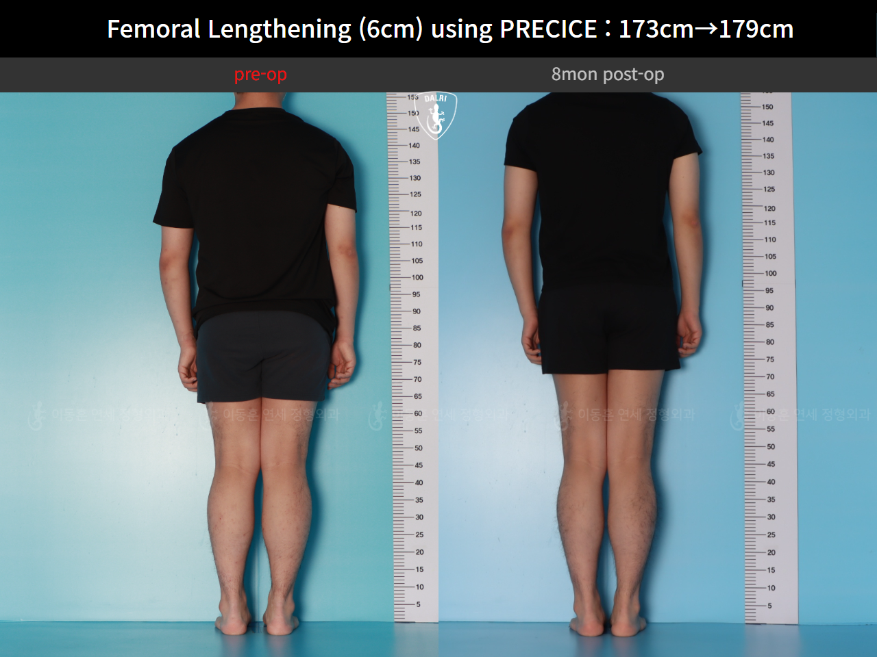 Before and after cll precice, case 89066969, image 2, Dr. Donghoon institute (DALRI)