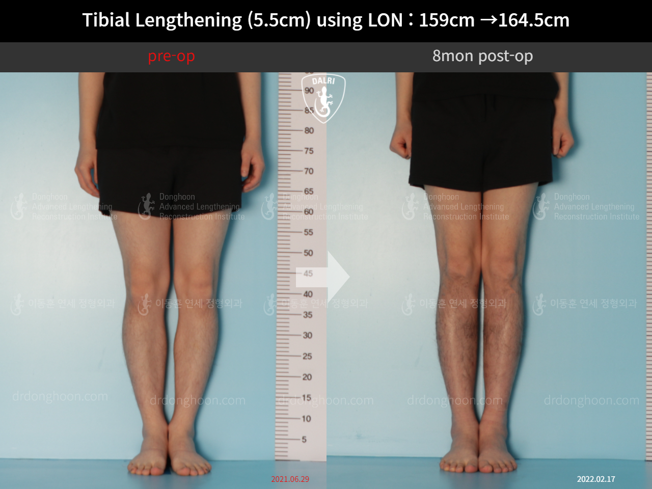 Before and after cll lon, case 10444923, image 5, Dr. Donghoon institute (DALRI)