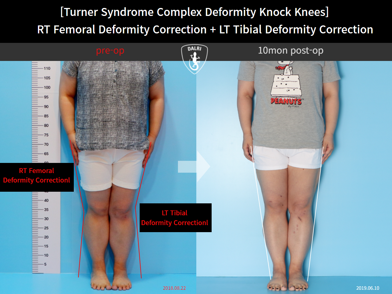 Before and after adult knock knees, case 10525297, image 1, Dr. Donghoon institute (DALRI)
