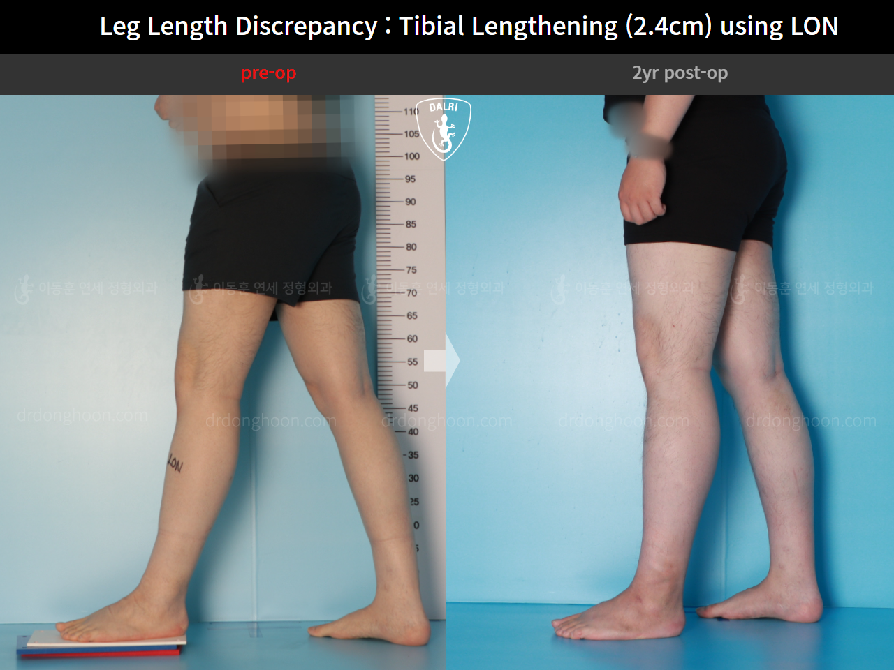 Before and after adult lld, case 15877698, image 7, Dr. Donghoon institute (DALRI)