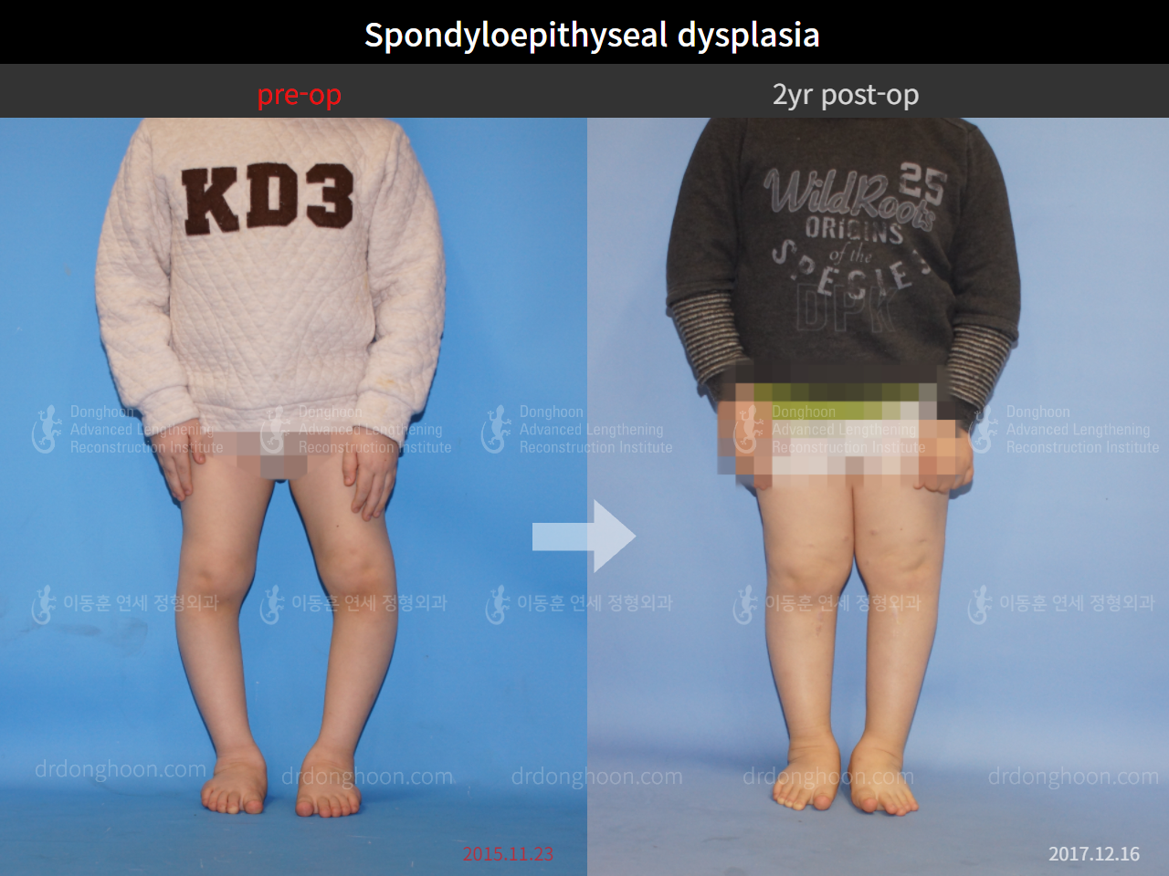 Before and after paediatric congenital condition, case 4304778, image 1, Dr. Donghoon institute (DALRI)