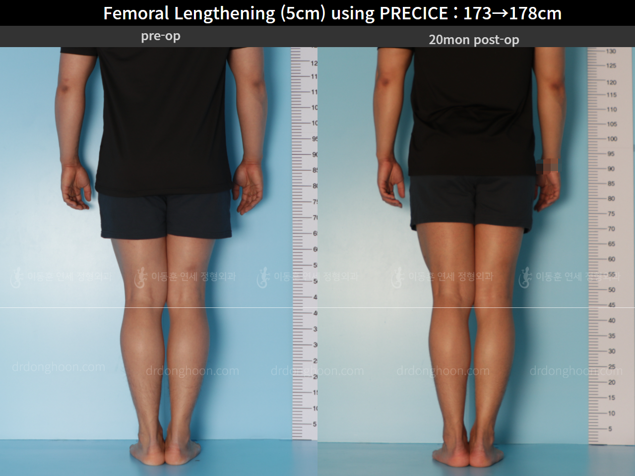 Before and after cll precice, case 4573533, image 6, Dr. Donghoon institute (DALRI)