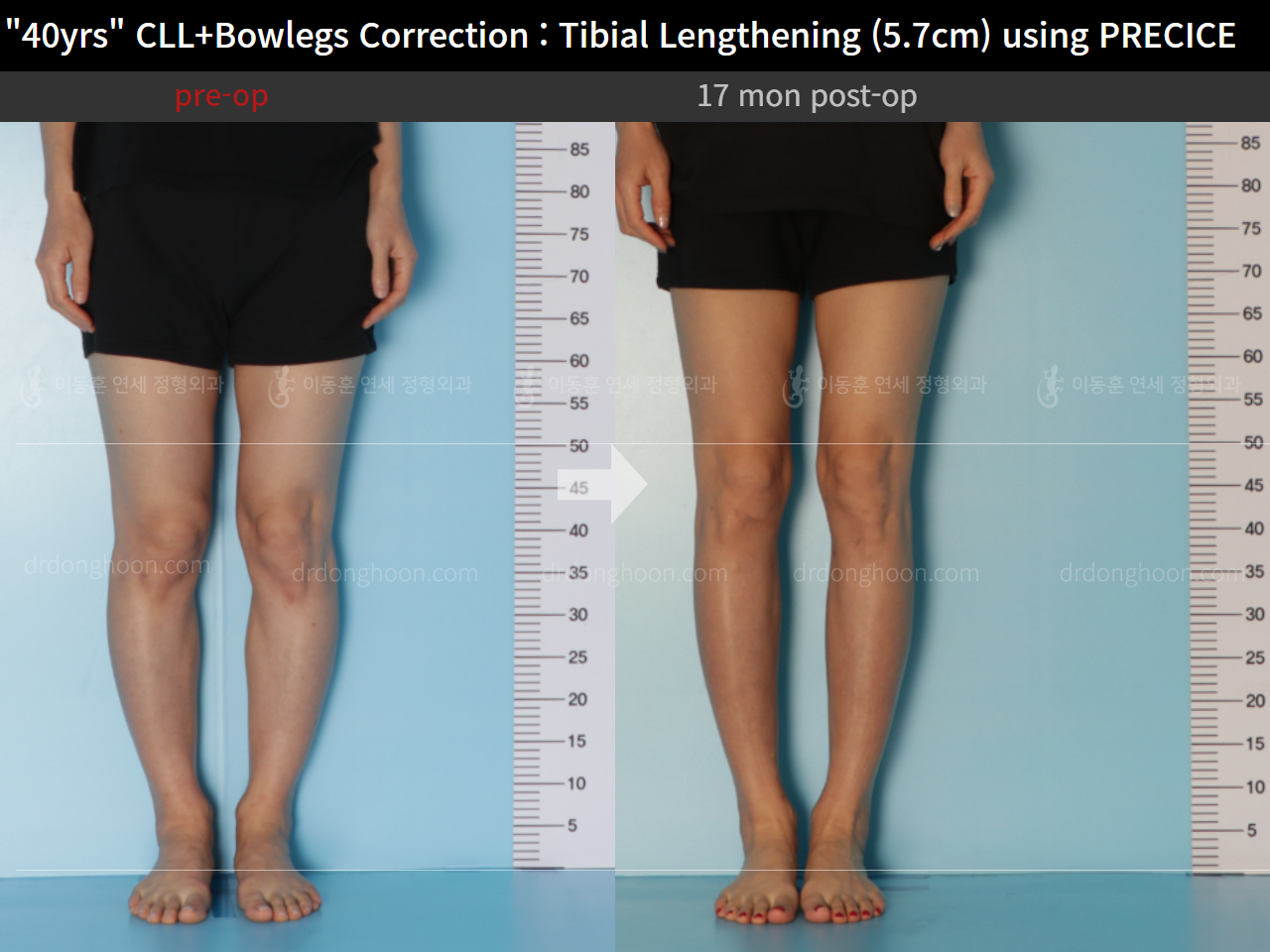 Before and after cll precice, case 9180903, image 5, Dr. Donghoon institute (DALRI)