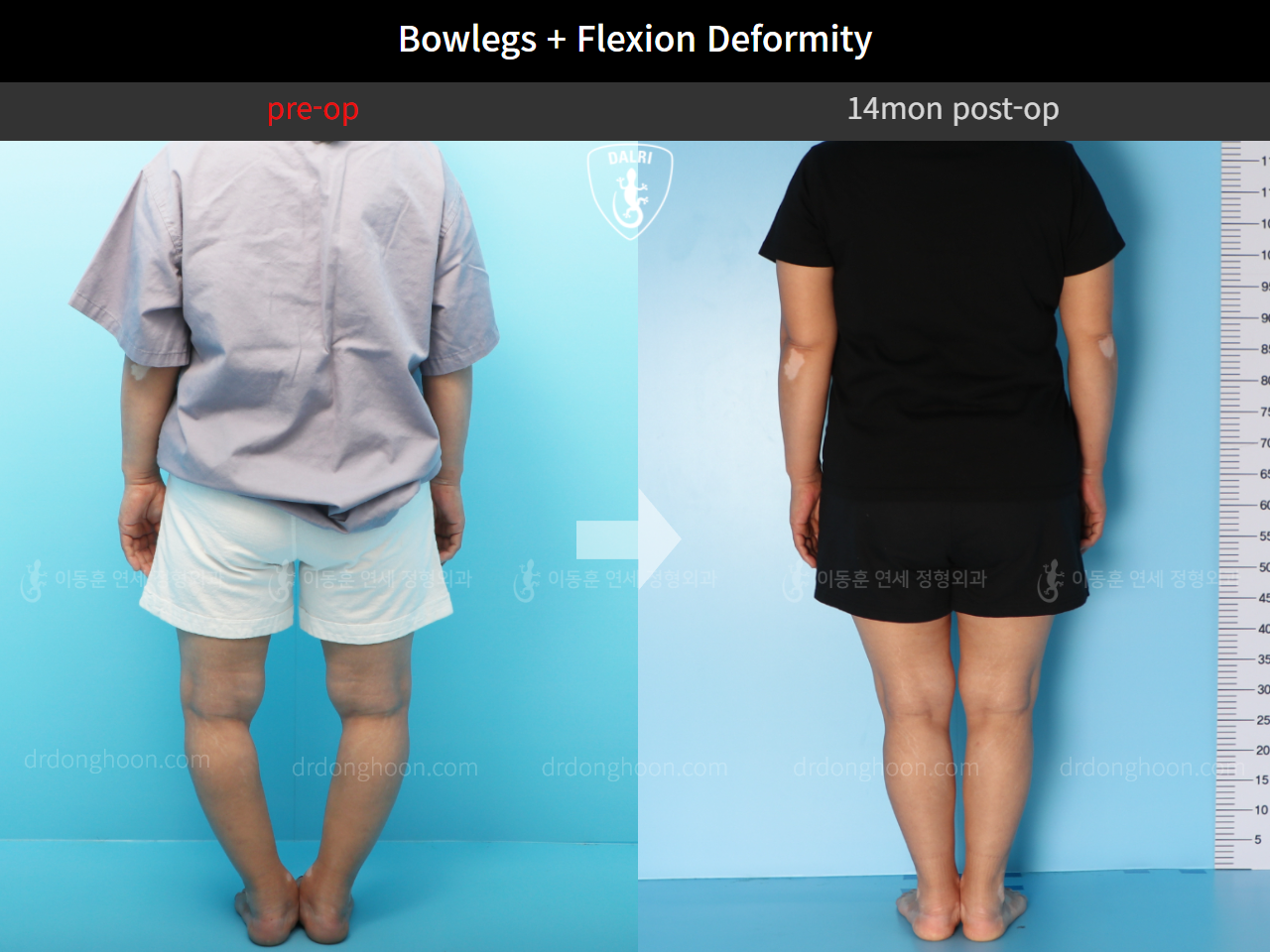 Before and after osteotomy for knee osteoarthritis, case 4586352, image 4, Dr. Donghoon institute (DALRI)