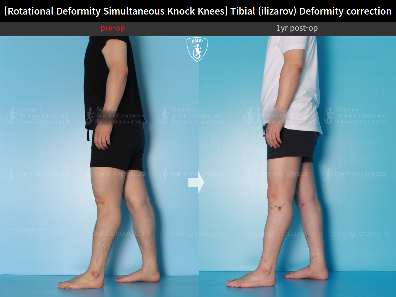 Before and after adult knock knees, case 15977455, image 3, Dr. Donghoon institute (DALRI)