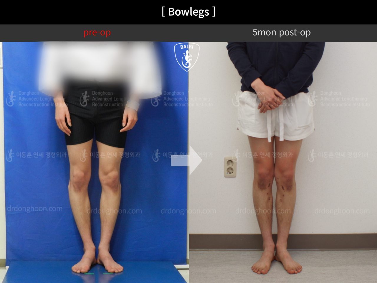 Before and after adult bowlegs, case 12756537, image 3, Dr. Donghoon institute (DALRI)